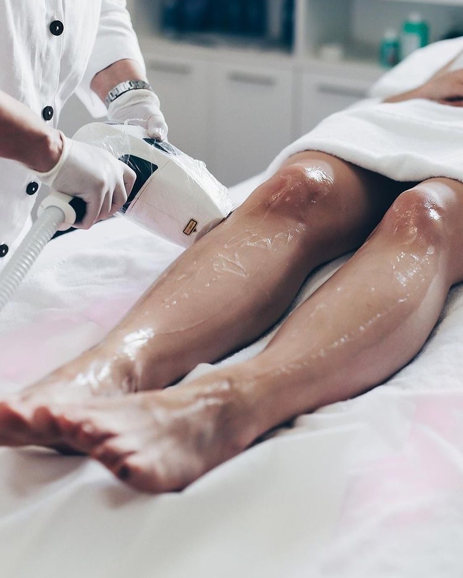 legs on laser epilation