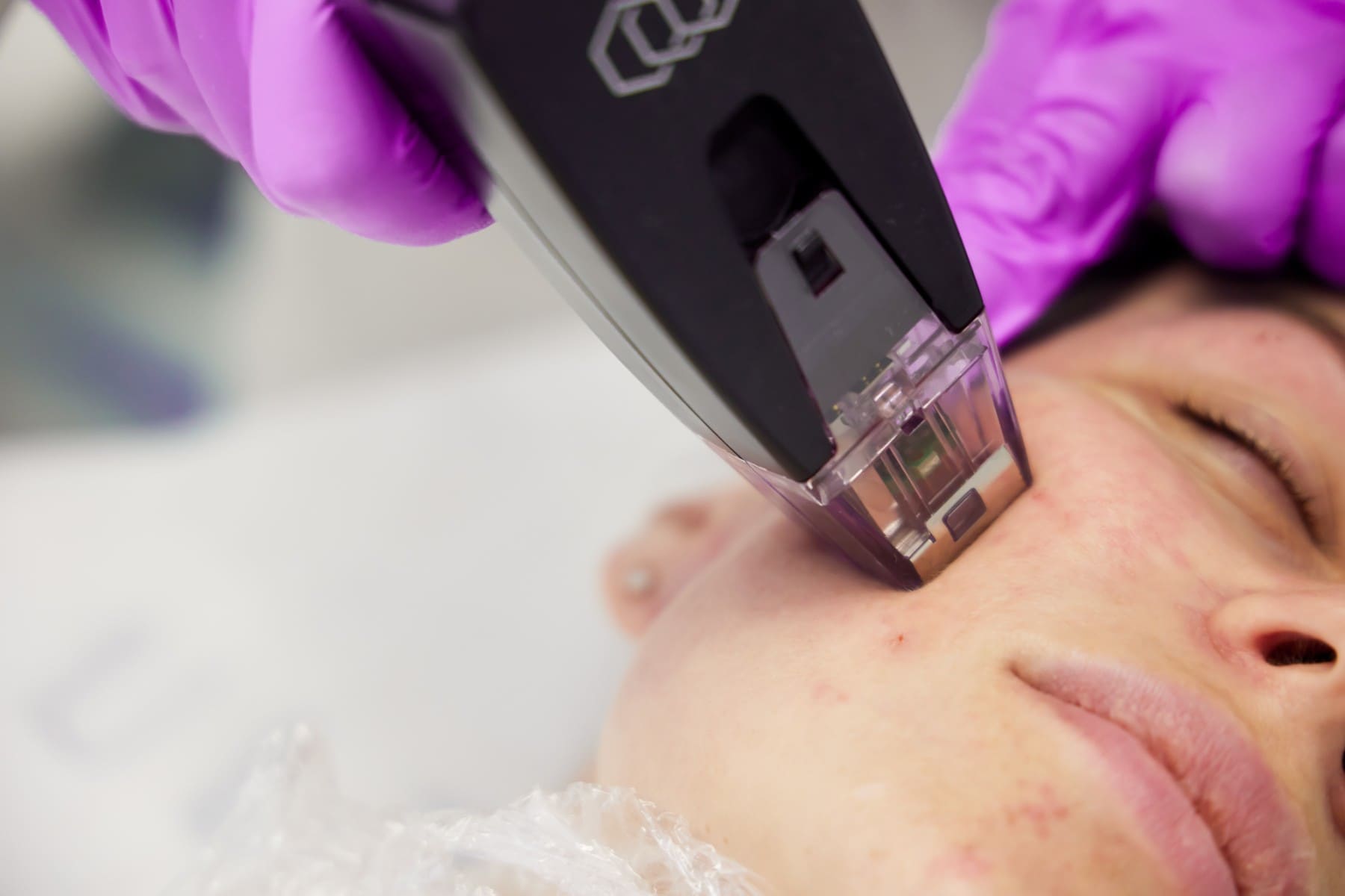 morpheus face treatment