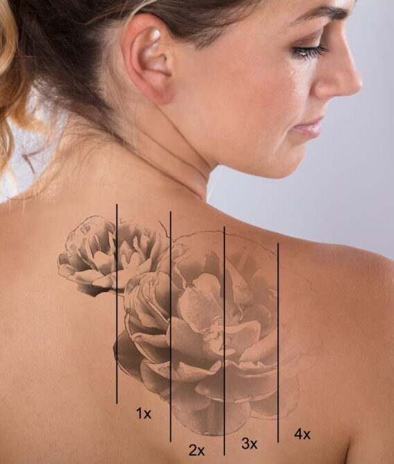 before after tattoo remove