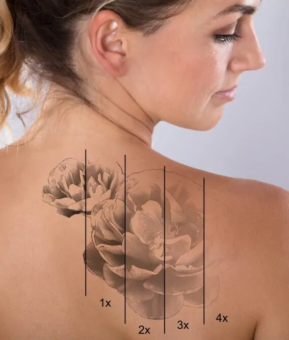before after tattoo remove