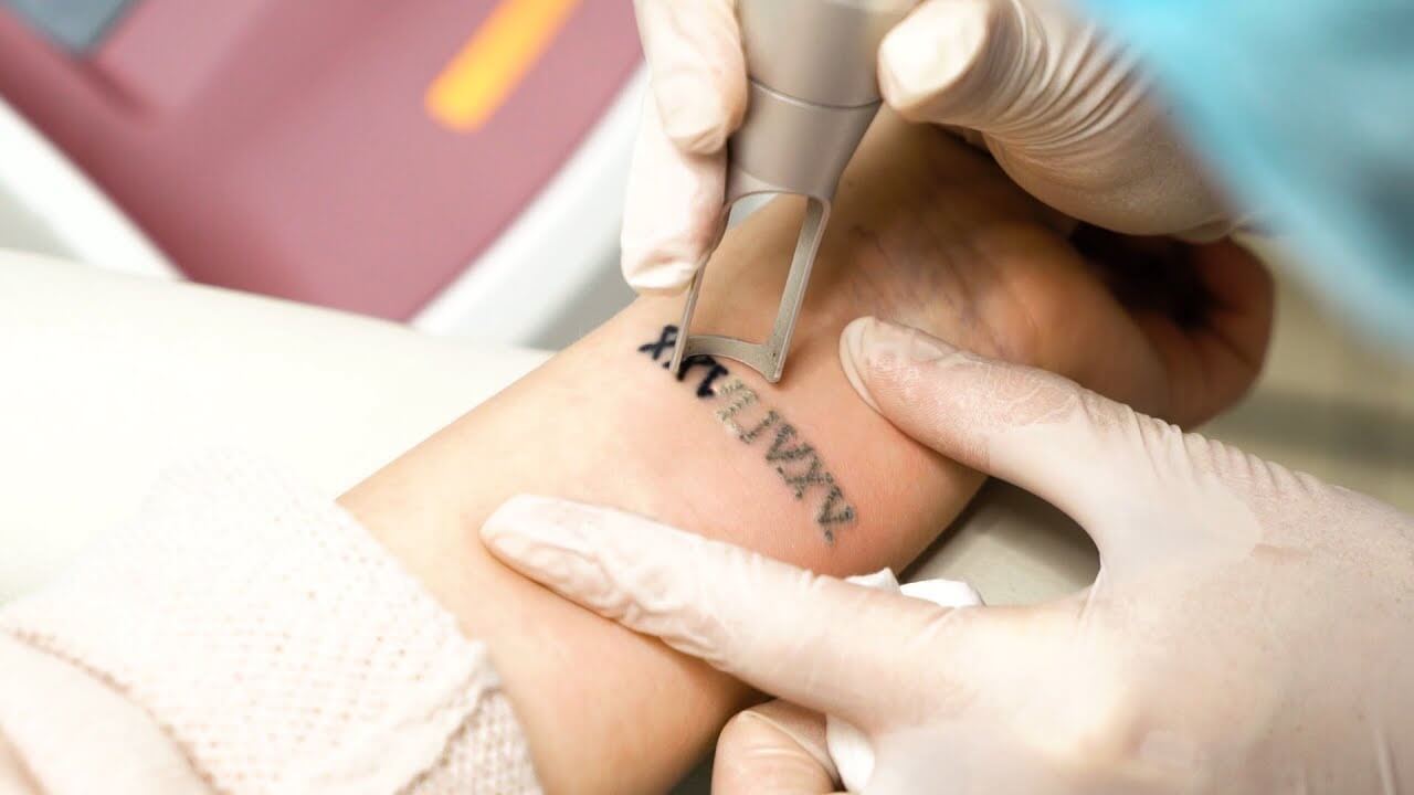 Tattoo and Permanent Makeup Removal