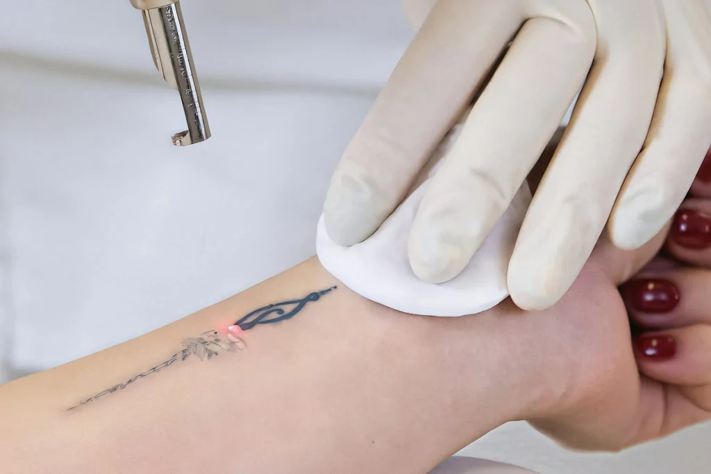 tatto remove from arm