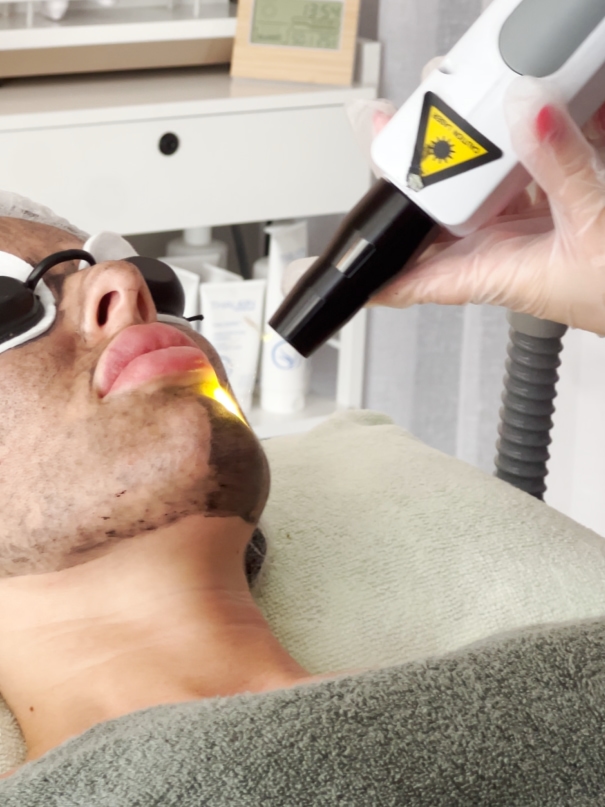 Углеродный пилинг